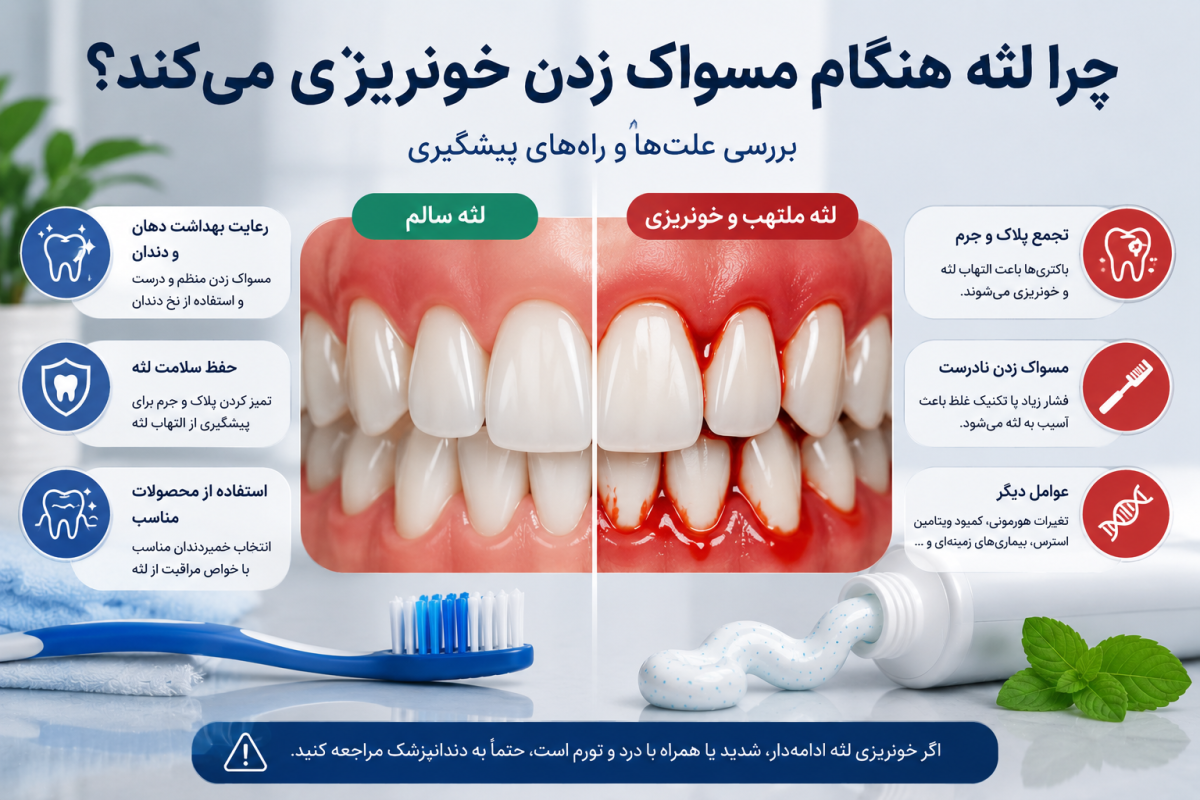 علت خونریزی لثه هنگام مسواک زدن